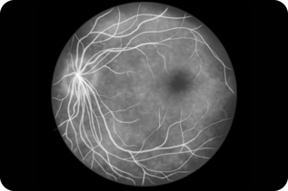 Fluorescein Angiography