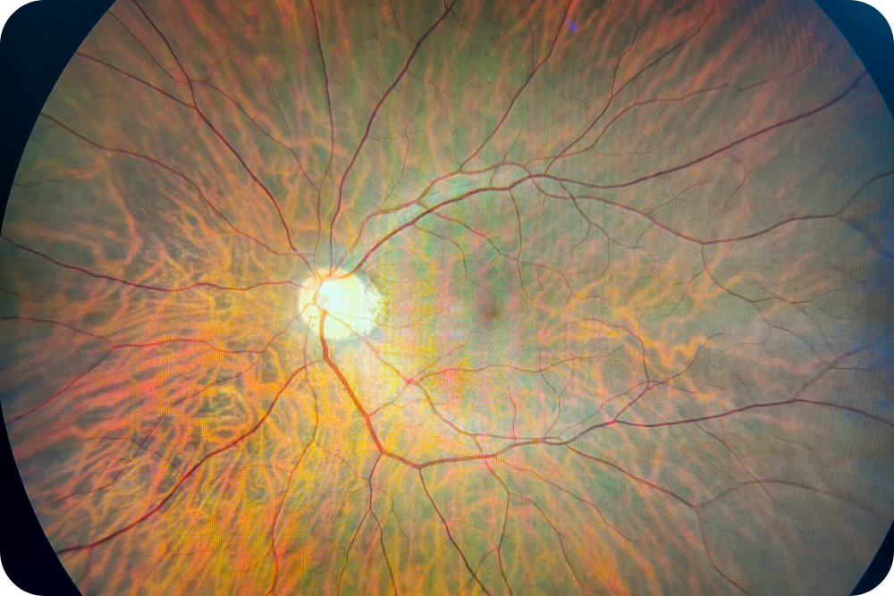 Wide-field Retinal Imaging