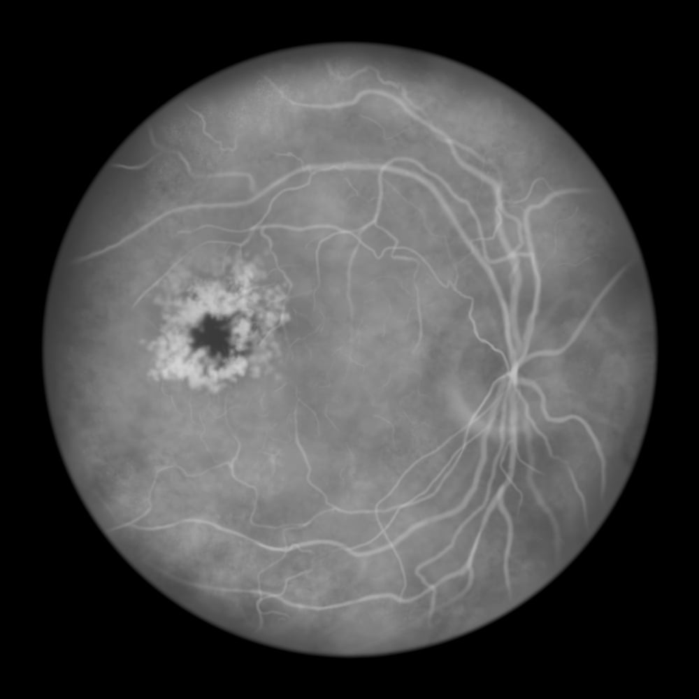 Wide-field retinal imaging used to detect peripheral retinal tears