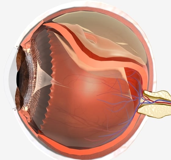 Diagram illustrating retinal detachment requiring urgent treatment