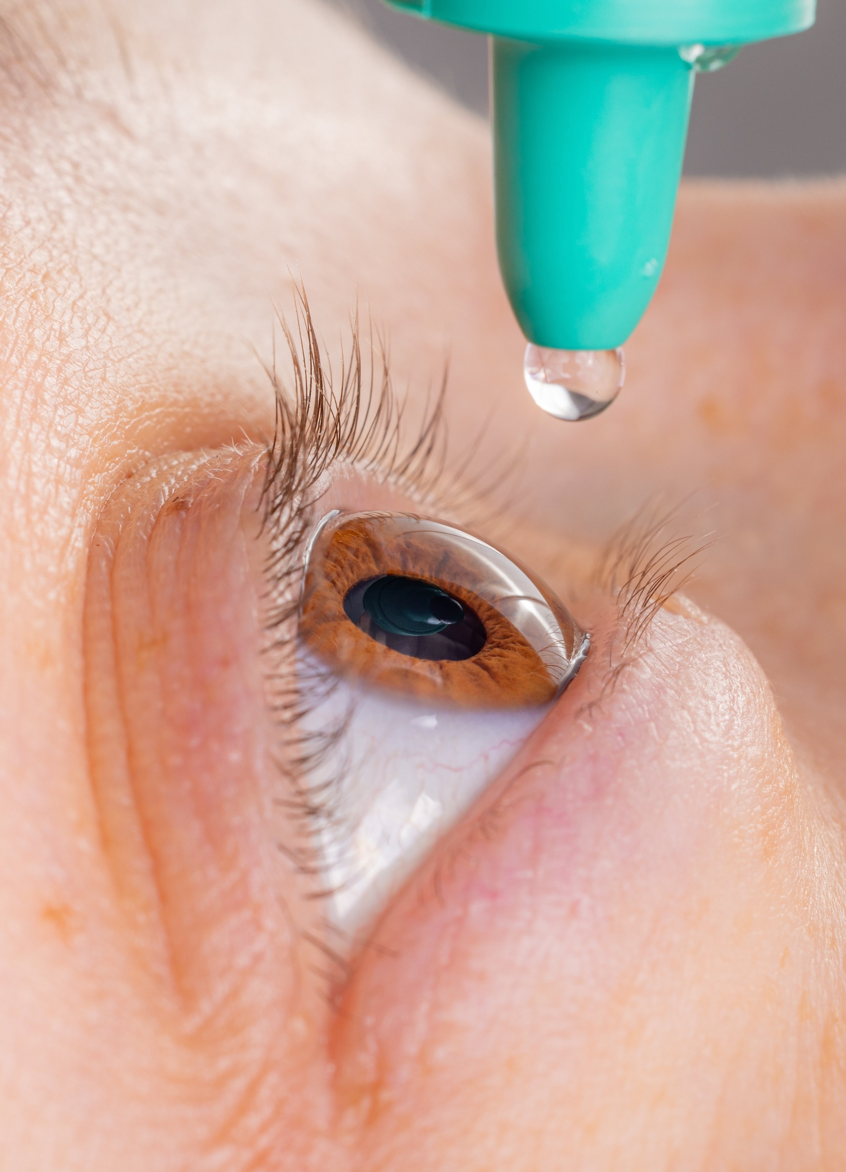 Optic nerve damage caused by glaucoma shown in diagnostic eye exam