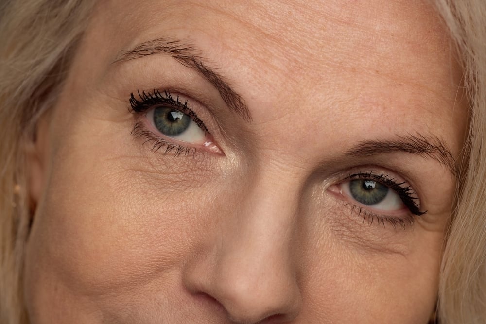 Brow lift surgery performed by oculoplastic specialist to elevate sagging eyebrows