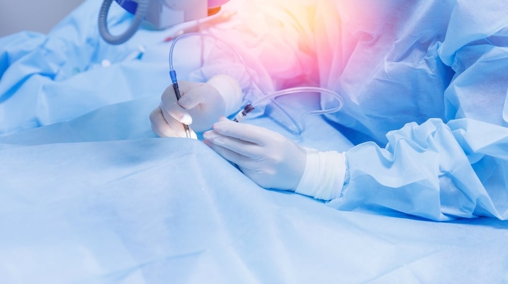 Precision laser-assisted cataract surgery technology at Southeast Eye Specialists visionamerica